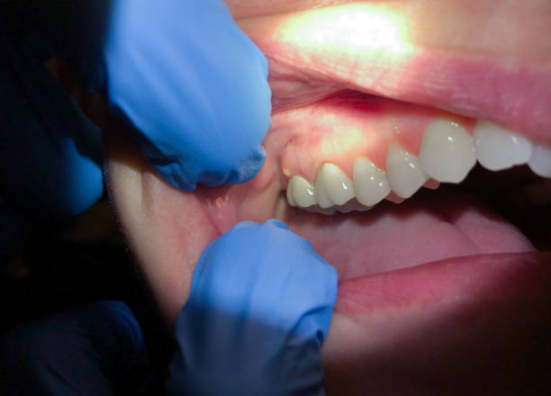 Best Emergency Dentist for Lost Fillings or Crowns in Jefferson, MD